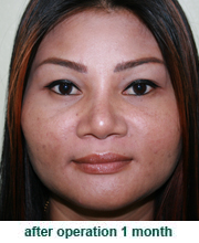 plastic_surgery_augmentation_rhinoplasty